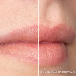 Before and after preview for lip
